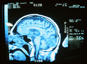 brain injuries in North Carolina